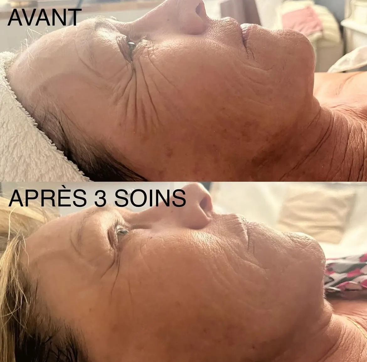 Soin anti-âge